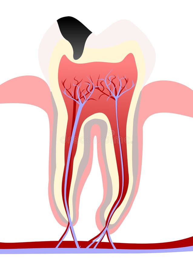 Tooth decay royalty free illustration