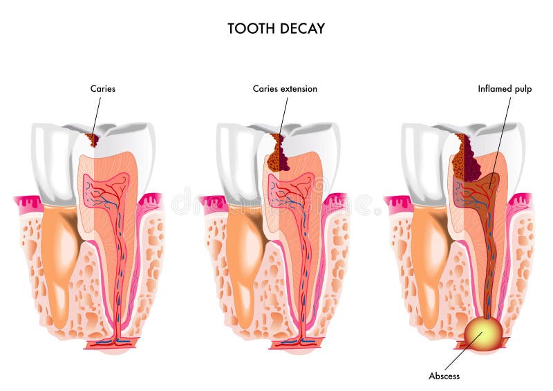 Tooth decay royalty free illustration