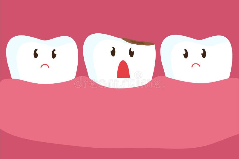 Tooth decay. Caries. Vector. stock illustration