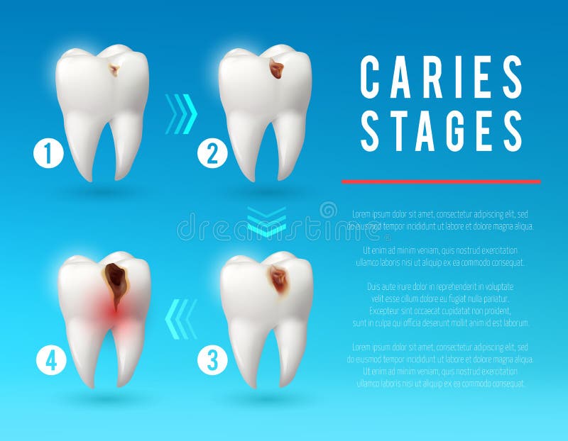 Tooth decay 3d poster of dental caries development. Tooth decay 3d vector poster. Teeth on different stages of dental caries development. Enamel and dentin decay royalty free illustration