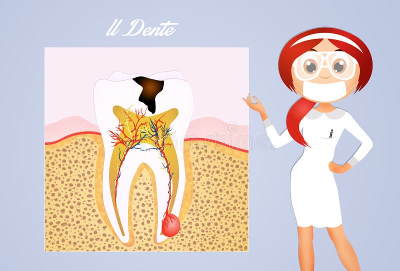 The tooth decay stock illustration