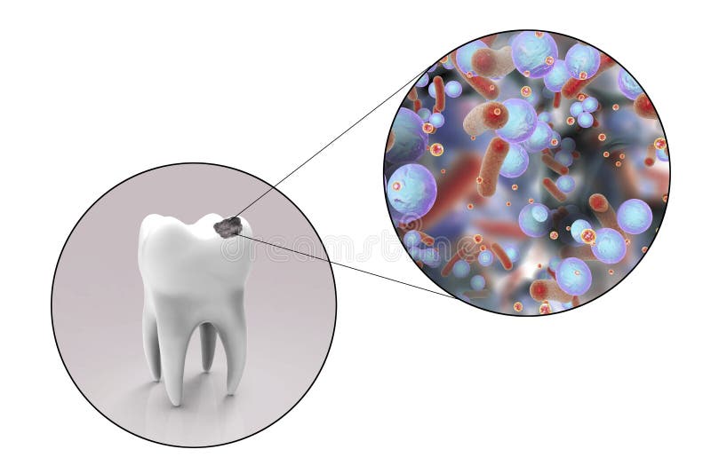 Tooth with dental caries. And close-up view of microbes which cause caries, 3D illustration vector illustration