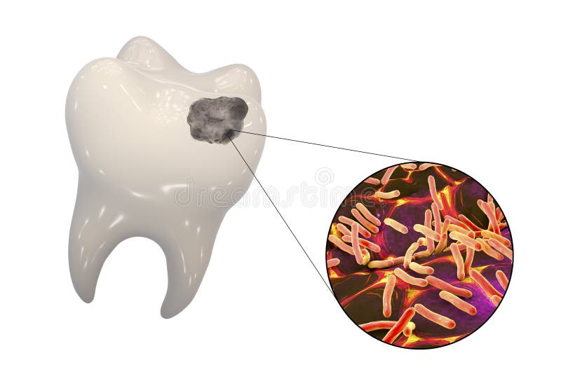 Tooth with dental caries. And close-up view of microbes which cause caries, 3D illustration stock illustration