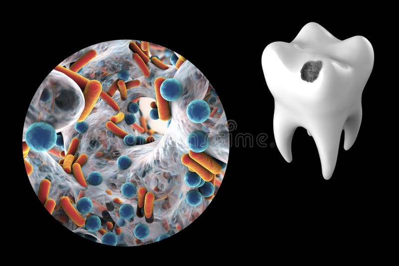 Tooth with dental caries. And close-up view of microbes which cause caries, 3D illustration royalty free illustration