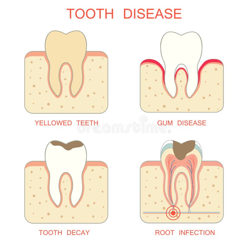 Tooth disease royalty free illustration