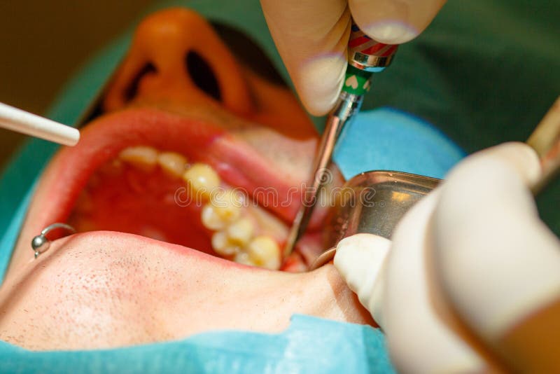 Tooth extraction without using forceps stock images