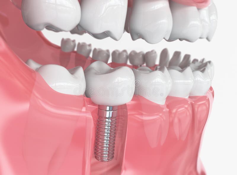 Tooth human implant - 3D Rendering. Tooth human implant. Dental concept. Human teeth or dentures. 3d rendering stock image