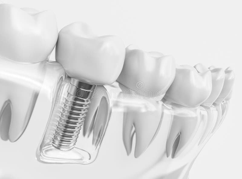 Tooth human implant - 3D Rendering. Tooth human implant. Dental concept. Human teeth or dentures. 3d rendering royalty free stock photography