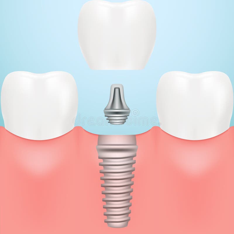 Tooth Human Implant. Dental Concept. Human Teeth Or Dentures Isolated On A Background. Vector Illustration. stock illustration