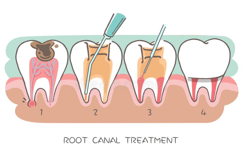 Tooth with root canal treatment royalty free illustration