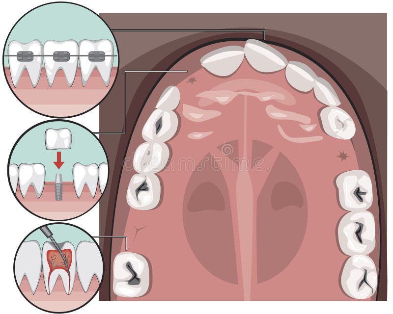 A top view of molars and incisors on the jaw caries before visiting the dentist or orthodontist, A vector stock illustration with. A vector stock infographic stock illustration