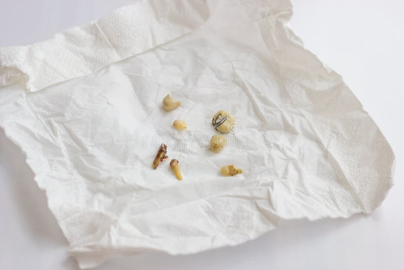 Torn out damaged tooth roots and used cermet dental crowns lie on white napkin. Close-up, shallow depth of field royalty free stock images