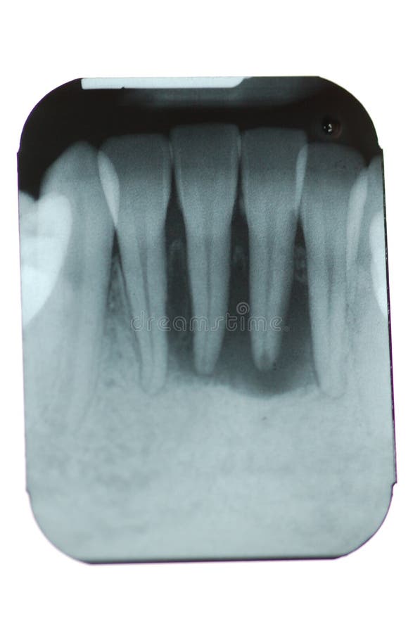 Total Periodontal Bone Loss. A dental xray (radiograph) of the lower front central incisors (teeth) showing complete destruction of the supporting bone around stock photo