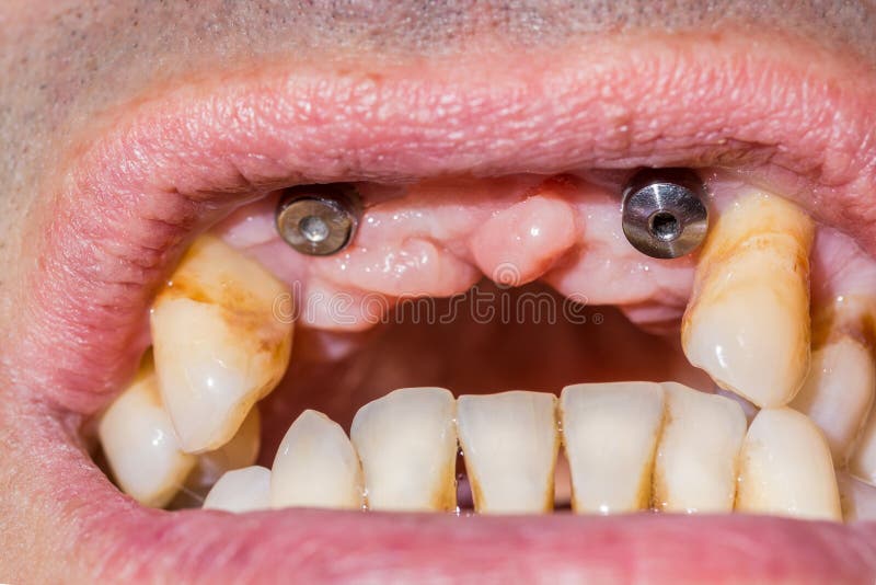Two canine dental implants in the mouth of a patient with advanced periodontitis stock images