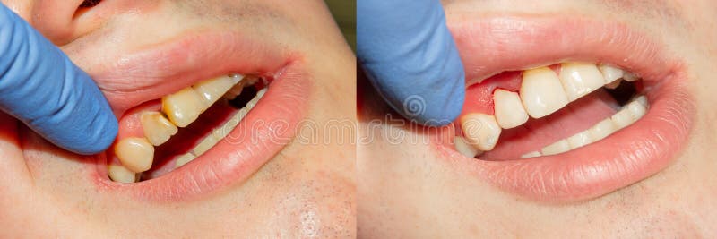 Two chewing side teeth of the upper jaw after treatment of caries. Restoration of the chewing surface with a photopolymer filling. Material using the Rubber Dam stock illustration