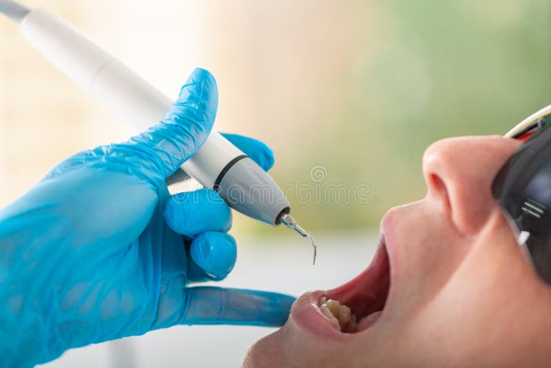Ultrasonic teeth cleaning, close-up. Removal of tartar, plaque. Paradontitis, paradantoz. Dentistry, healthy teeth stock images