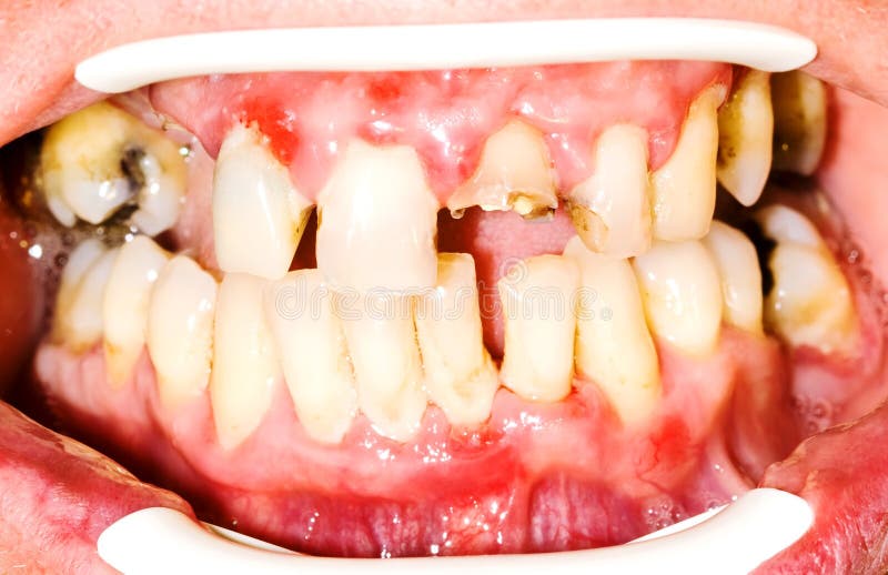 Unhealhty teeth stock photography