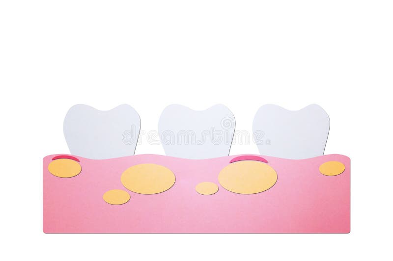 Unhealthy teeth because gingivitis with abscess in gum and dental plaque or tartar. Tooth cartoon paper cut style cute character for design royalty free illustration