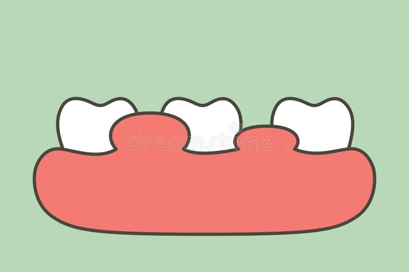 Unhealthy teeth because gingivitis or gum disease with abscess, gum is swollen. Dental cartoon vector flat style cute character for design royalty free illustration