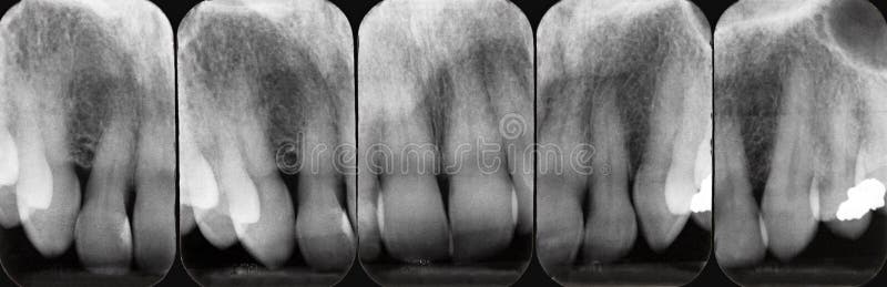 Upper Periodontal X-rays. X-rays revealing periodontal disease of the gum and bone. Desaturated color image stock image