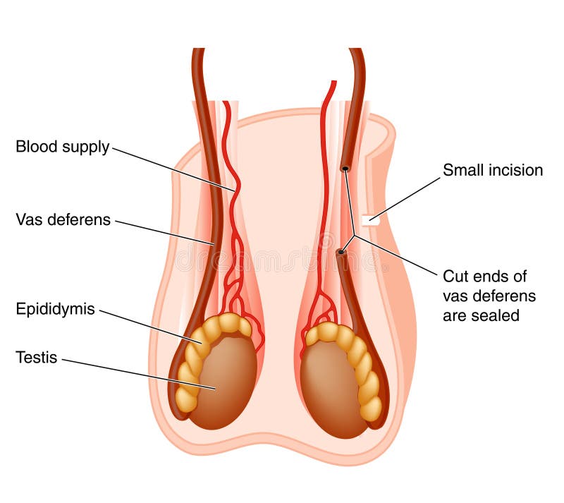 Vasectomy operation royalty free illustration