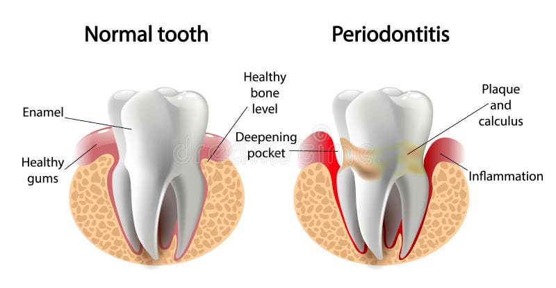 Vector image tooth Periodontitis disease royalty free illustration