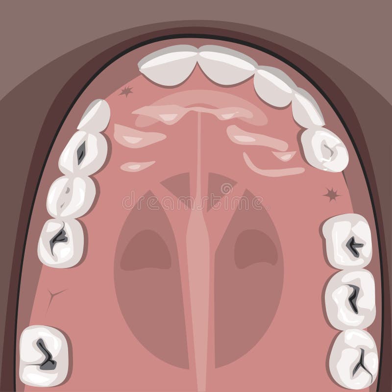 A caries and jaw of an adult with molars top view before visiting the dental clinic, a vector stock illustration with teeth and. A vector stock illustration with royalty free illustration