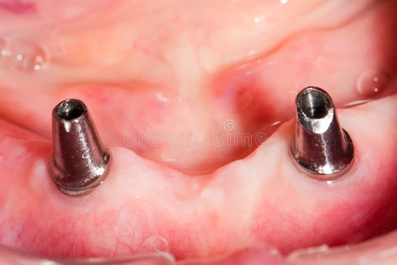 Very old dental bridge royalty free stock photography