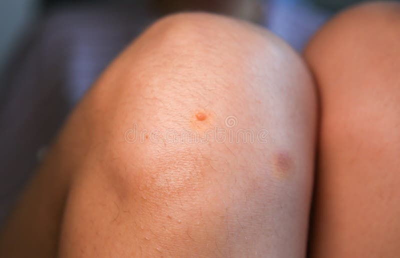 Wart on the knee. Mole on woman`s leg. Papilloma problem. Skin disease. Medical treatment photo.  royalty free stock photography