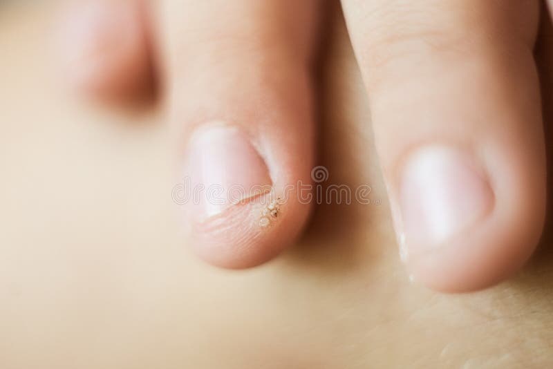Wart, papilloma on a childs finger. Macro shot, selective focus, close-up, space for text. Dermatological problems with the skin.  stock images
