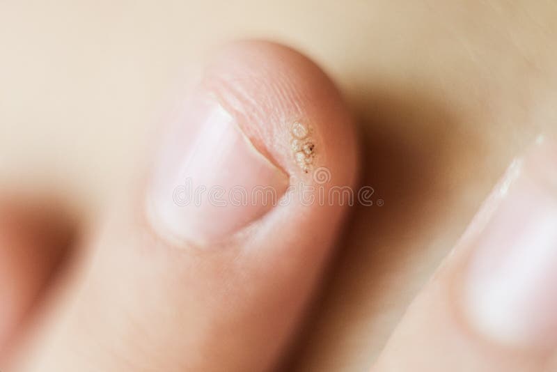 Wart, papilloma on a childs finger. Macro shot, selective focus, close-up, space for text. Dermatological problems with the skin.  stock photos