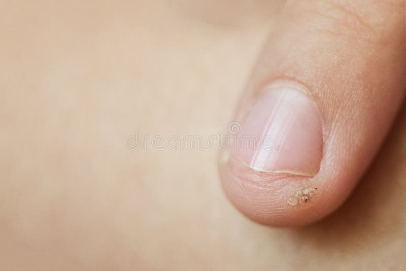 Wart, papilloma on a childs finger. Macro shot, selective focus, close-up, space for text. Dermatological problems with the skin.  royalty free stock images