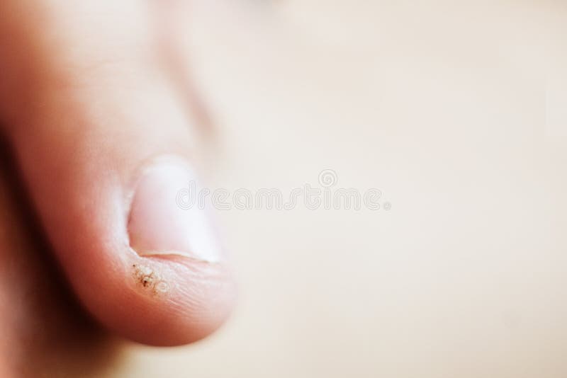 Wart, papilloma on a childs finger. Macro shot, selective focus, close-up, space for text. Dermatological problems with the skin.  royalty free stock photography
