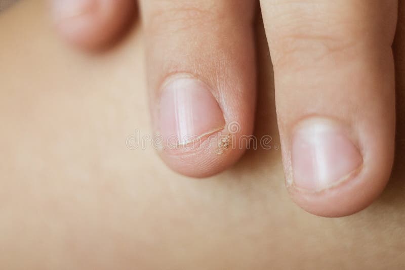 Wart, papilloma on a childs finger. Macro shot, selective focus, close-up, space for text. Dermatological problems with the skin.  stock image