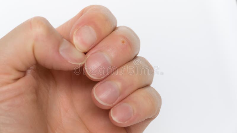 Warts, corns on the middle finger on a man`s hand with overgrown nails stock image