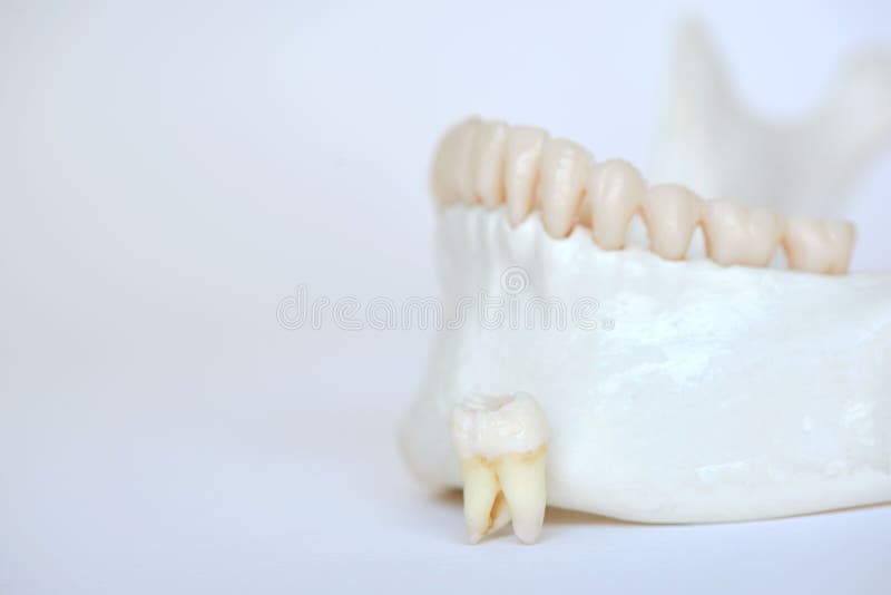 A wisdom molar tooth on human jaw model. An extracted wisdom molar tooth on human jaw model stock photography