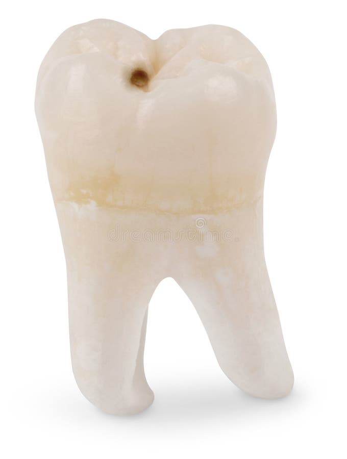 Wisdom Tooth with Cavity. Human wisdom tooth isolated on white with a clipping path stock image