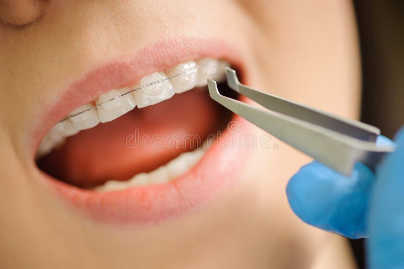 Woman with ceramic braces on teeth at the dental office royalty free stock photo