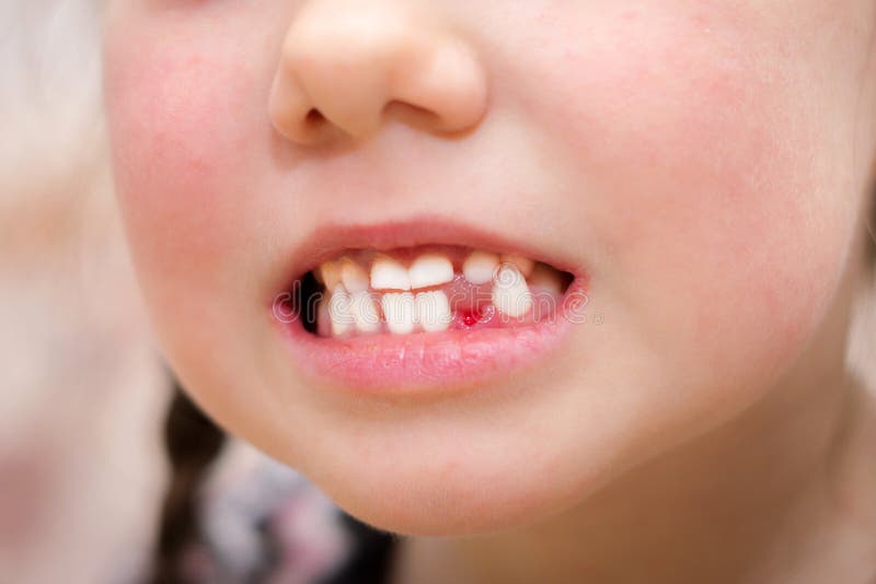 A wound in a child`s mouth without one tooth is close-up. The girl just pulled out her baby teeth. Children`s smile after visiti stock image