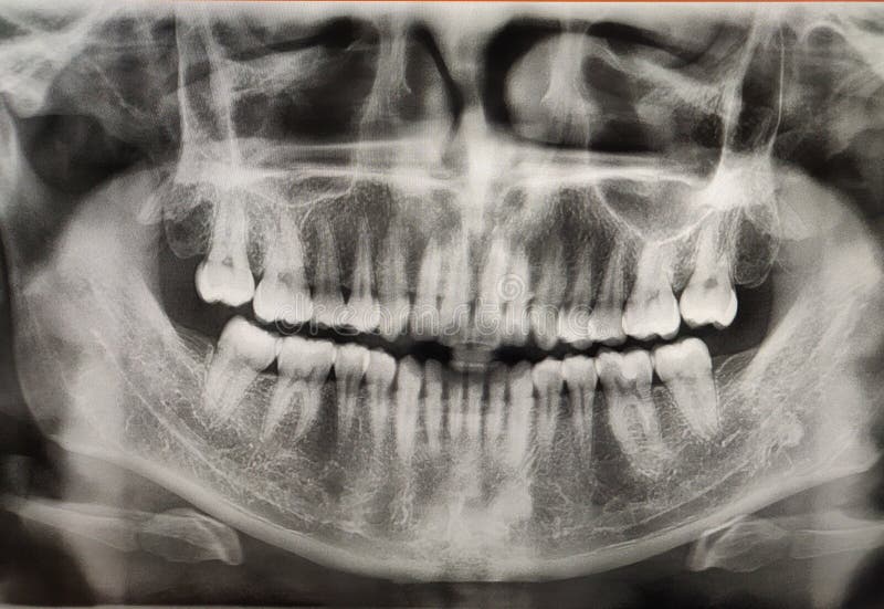 X ray film of human mouth with healthy teeth. Detail of panoramic facial x-ray image stock photography