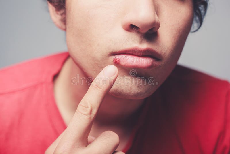 Young man with cold sore royalty free stock image
