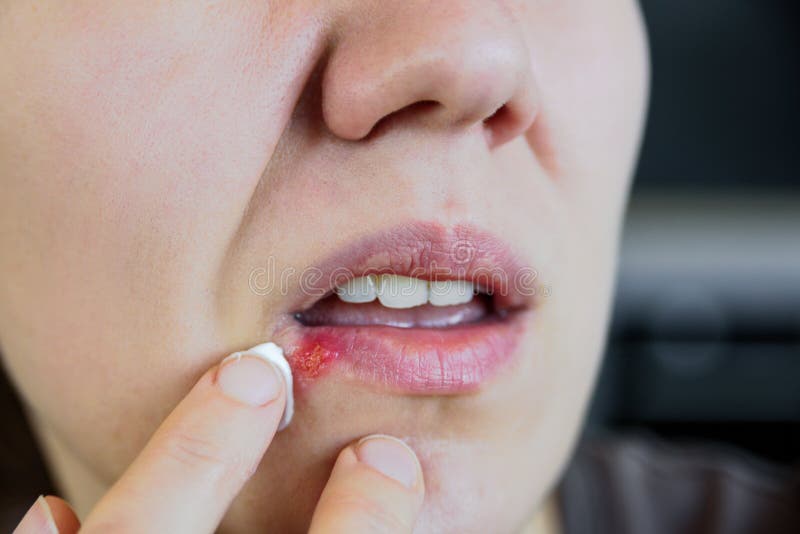 Young woman using ointment to heal her lip herpes. Young woman using salve to heal her lip herpes. Emotions, pain stock image
