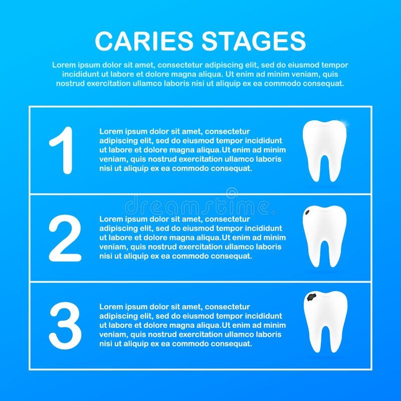 Stage of development of caries. Dental care concept. Healthy Teeth. Vector illustration. Stage of development of caries. Dental care concept. Healthy Teeth stock illustration