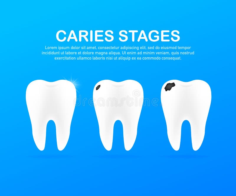 Stage of development of caries. Dental care concept. Healthy Teeth. Vector illustration. Stage of development of caries. Dental care concept. Healthy Teeth vector illustration