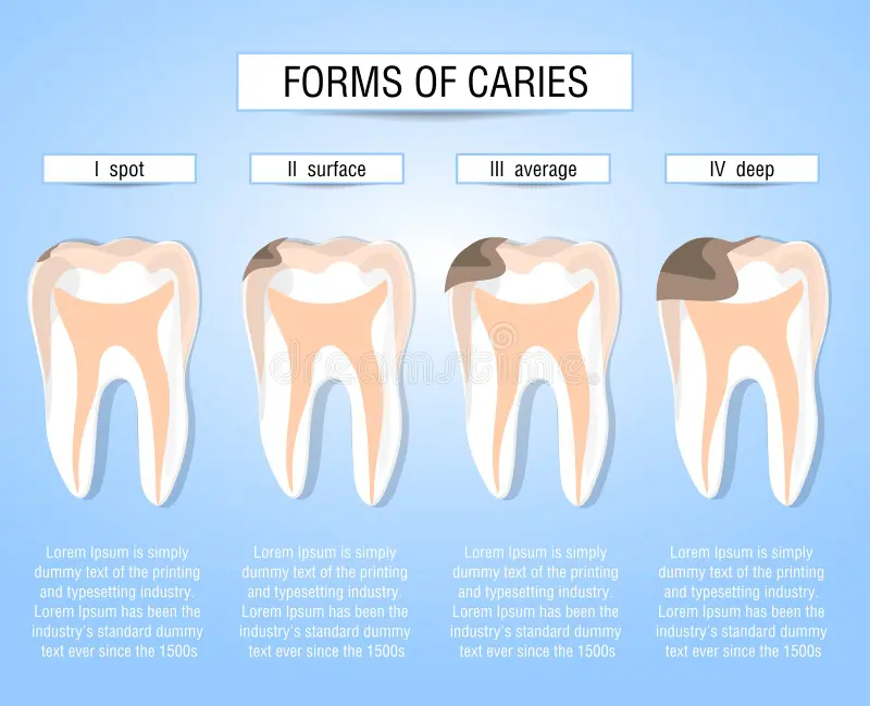 Caries stages of development. Visual aid for students, dentists, clinic patients. Defeat the source of destruction in the teeth. V vector illustration