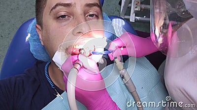 The dentist works with tools with a filling. Caries treatment, restoration of a decayed tooth, professional help, root canal filli. Caries treatment, restoration stock video footage