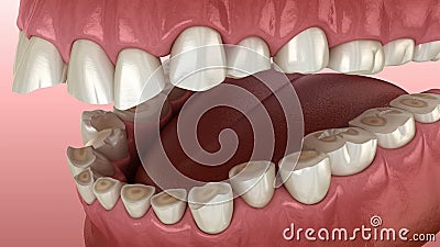 Dental attrition Bruxism resulting in loss of tooth tissue.  Medically accurate tooth 3D animation. Dental attrition Bruxism resulting in loss of tooth tissue vector illustration