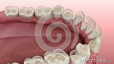 Dental attrition Bruxism resulting in loss of tooth tissue.  Medically accurate tooth 3D animation. Dental attrition Bruxism resulting in loss of tooth tissue vector illustration
