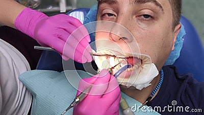 The dentist works with tools with a filling. Caries treatment, restoration of a decayed tooth, professional help, root canal filli. Mouth pain relief concept stock video