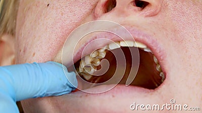 The hole in the tooth and the treatment of dental canals. Treatment of periodontitis in the dental clinic. Treatment of periodontitis in the dental clinic. The stock video